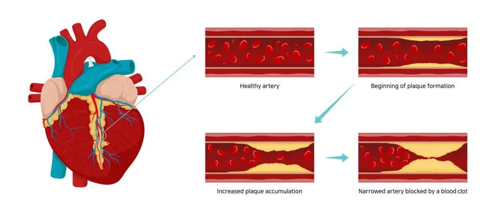 Illustration showing the heart and stages of artery health: from healthy, to plaque formation, increased accumulation, and blockage by a clot.