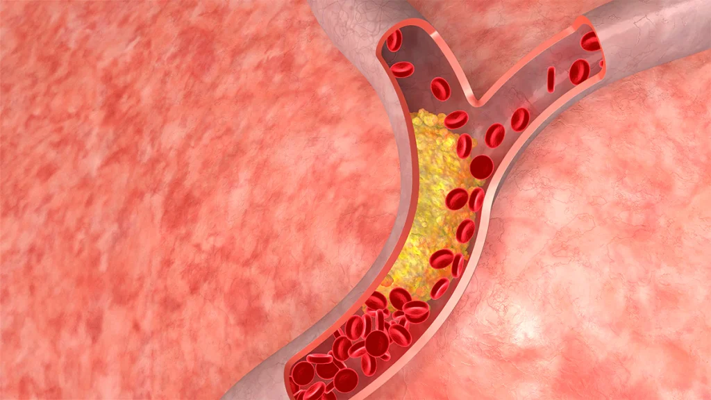 Illustration of a blood vessel showing red blood cells and fatty deposits, highlighting potential blockage in the circulatory system.