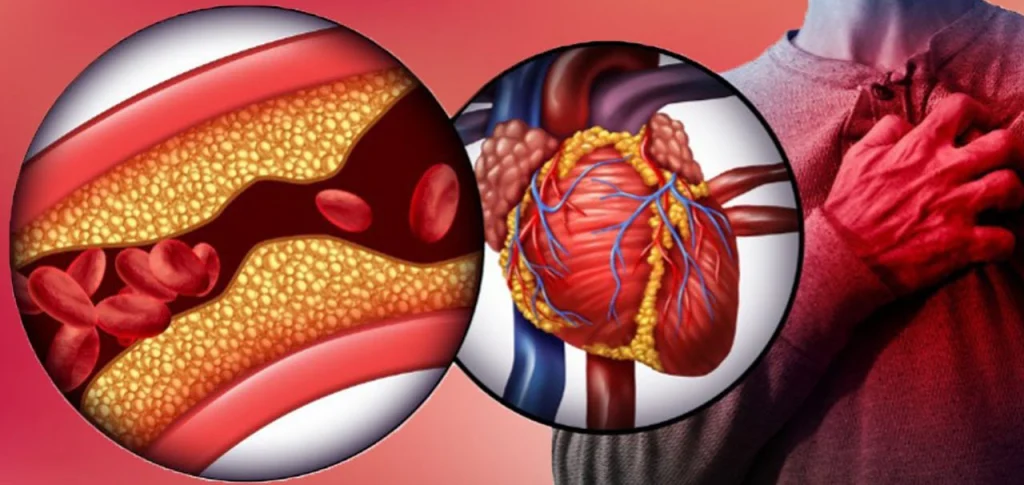 An illustration of a clogged artery and heart, with a person clutching their chest, symbolizing heart health concerns.