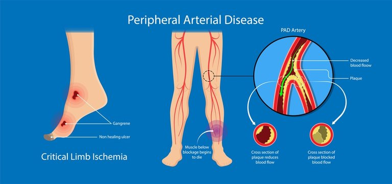 Illustration of Peripheral Arterial Disease showing critical limb ischemia, gangrene, and artery blockage reducing blood flow.
