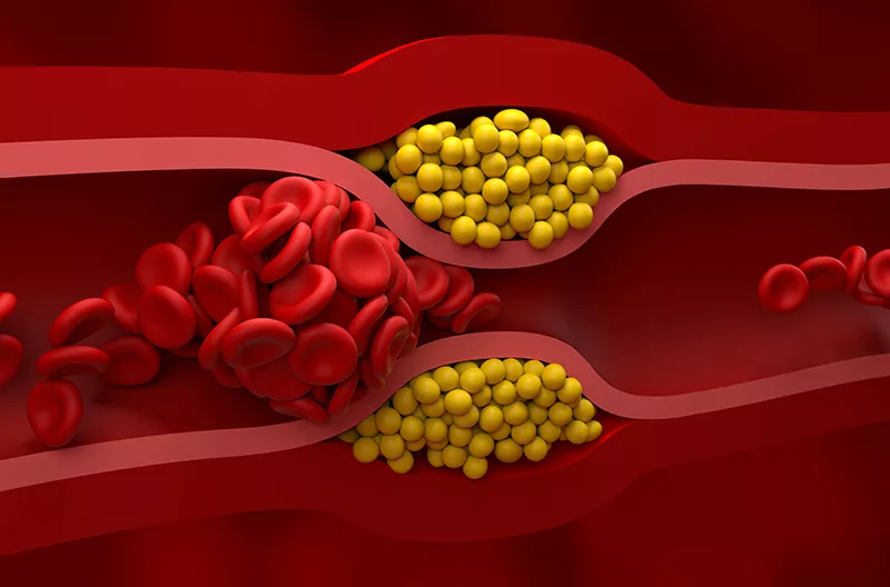 Illustration of blood vessels showing red blood cells and yellow fat deposits, highlighting potential for blockage and vascular issues.