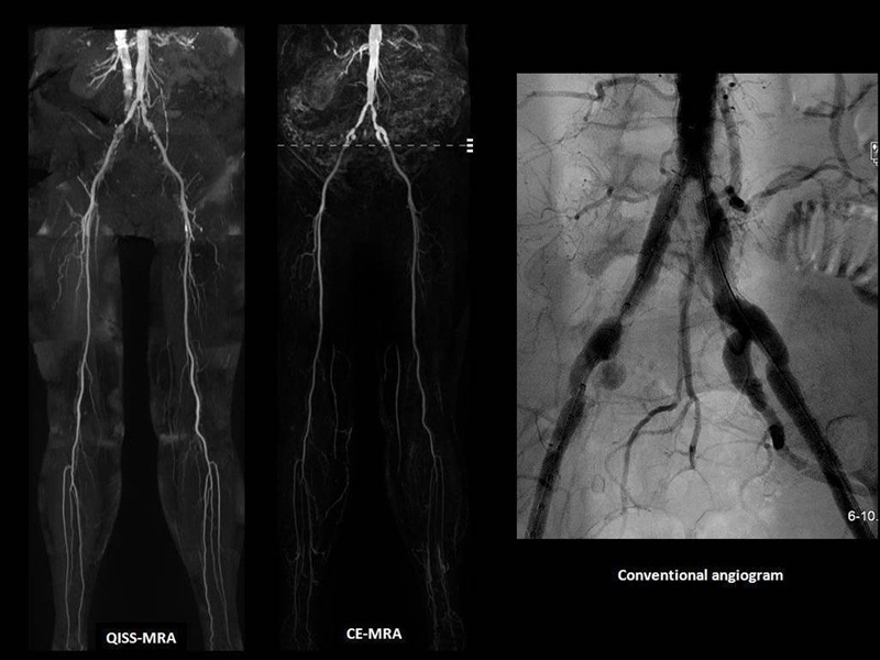Three types of vascular imaging: QISS-MRA on the left, CE-MRA in the center, and a conventional angiogram on the right.