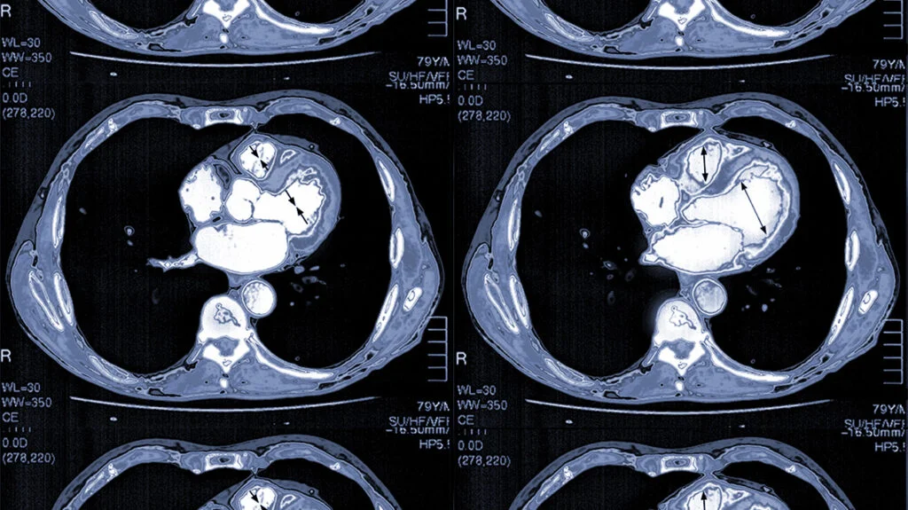 Four consecutive CT scan images of the chest showing cross-sections of the heart and surrounding structures with highlighted areas.