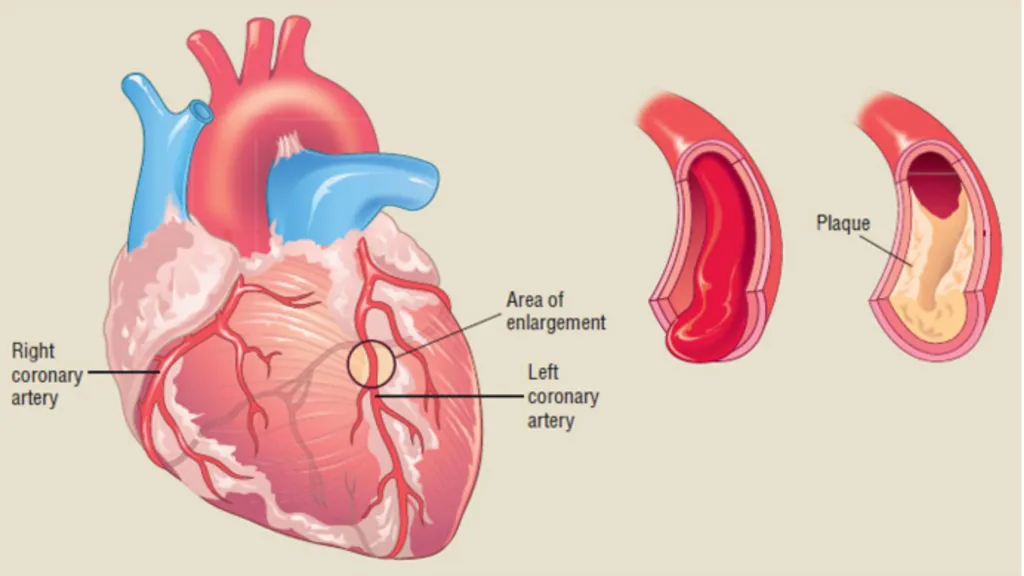 An anatomical illustration of the heart showing coronary arteries, plaque formation, and an area of enlargement.