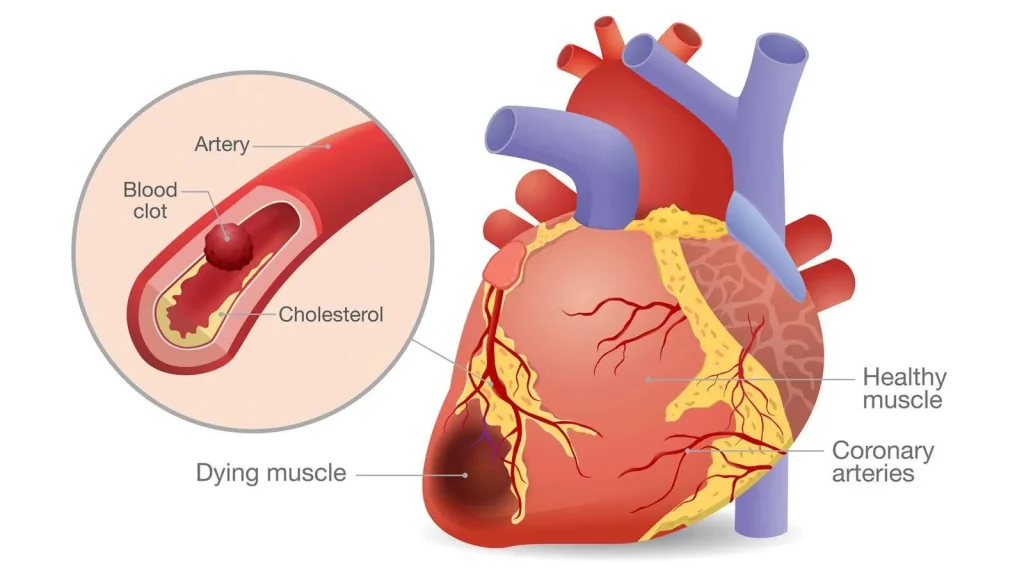 Illustration of a human heart with labels for coronary arteries, healthy muscle, and a blood clot inside an artery, indicating heart health issues.